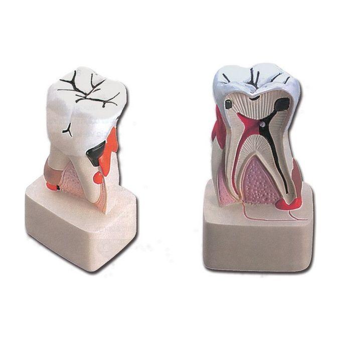 Modello Patologia Dentale 1